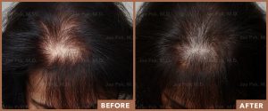 JPMD-Before-And-After-Hair-Transplantation-12