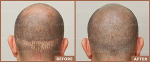 JPMD-Before-And-After-Hair-Transplantation-13