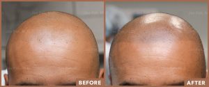 JPMD-Before-And-After-Hair-Transplantation-17