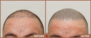 JPMD-Before-And-After-Hair-Transplantation-2