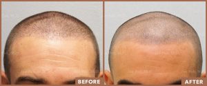 JPMD-Before-And-After-Hair-Transplantation-26