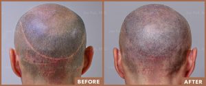 JPMD-Before-And-After-Hair-Transplantation-45