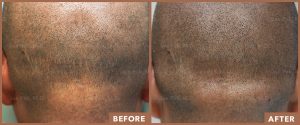 JPMD-Before-And-After-Hair-Transplantation-5