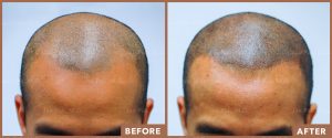 JPMD-Before-And-After-Hair-Transplantation-50