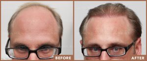 JPMD-Before-And-After-Hair-Transplantation-52