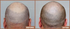 JPMD-Before-And-After-Hair-Transplantation-53