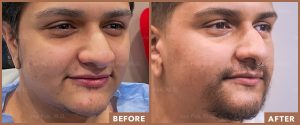 Transgender Beard Transplant Patient by Dr. Pak