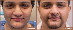 Transgender Beard Transplant Patient by Dr. Pak
