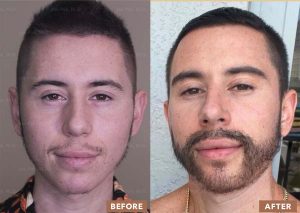 jpmd_beard_transplant_before_after_202022