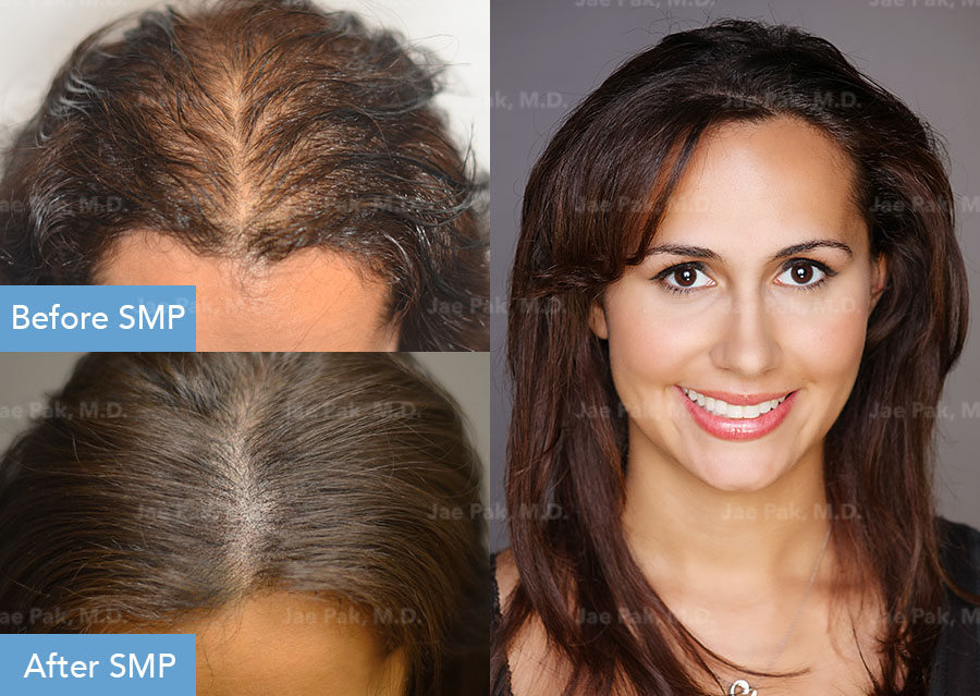 Before and After SMP Treatment for Female Patient