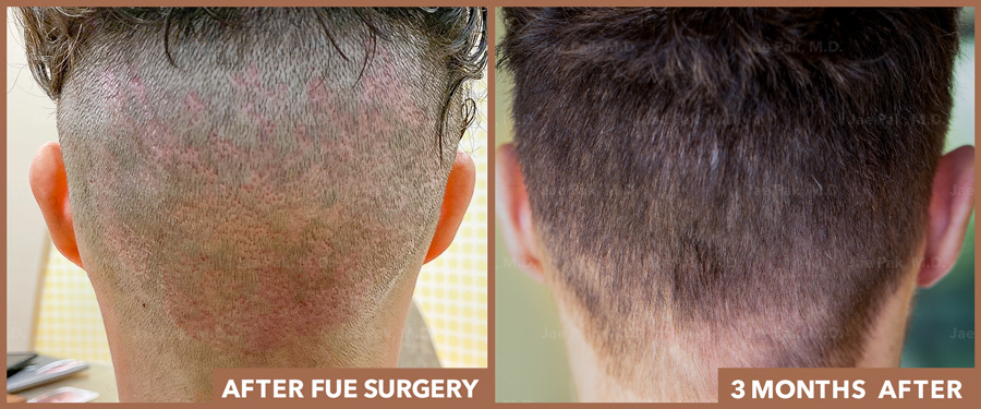 Back of Scalp - Scars from FUE After Procedure and 3 Months Later