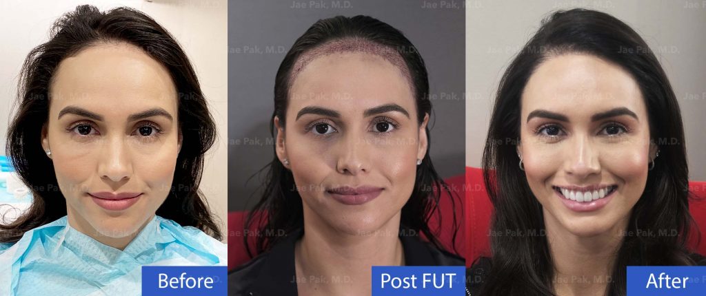 Hairline Lowering Patient Before, Post Procedure and After