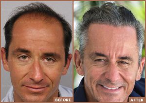 Before and After FUE Hair Transplant