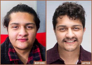 hair_transplant_fue_fut_before_after
