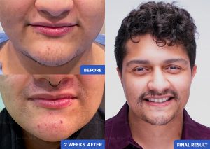 hair_transplant_fue_fut_before_after_202105_panel